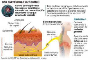 Herpes zóster: La pandemia dispara un 20% los casos en España
