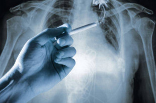 Un nuevo tratamiento probado en España multiplica por seis los cánceres de pulmón que desaparecen por completo
