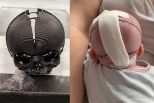 Una empresa de tecnología de Varsovia salva la vida de un bebé que nació con un cráneo subdesarrollado después de imprimir un cráneo en 3D (inglés)